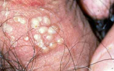 感染生殖器疱疹危害有多大？