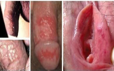 感染了生殖器疱疹会出现什么样的症状