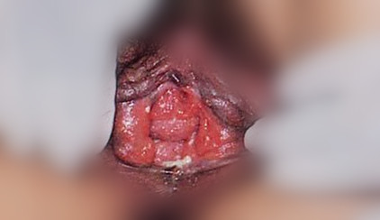 感染上生殖器疱疹的症状是怎样的